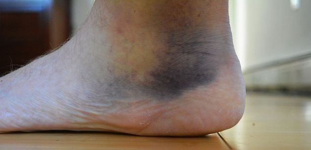 My foot 9 days after marathon